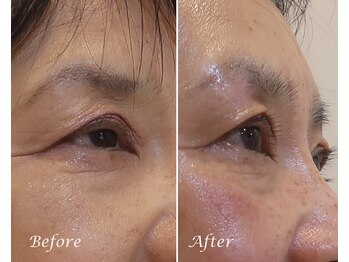 ドクターボディ 新宿店(Dr.Body)/【目の開き/まぶた 60代】