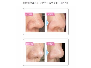 ニコ(nico)/毛穴洗浄エイジングベースプラン