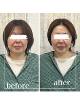 リリーガーデン 手稲店(Lily Garden)/ビフォーアフター　小顔/むくみ