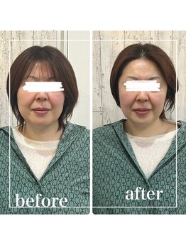 リリーガーデン 手稲店(Lily Garden)/ビフォーアフター 小顔/むくみ
