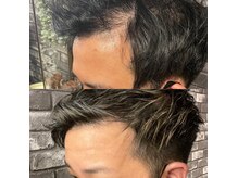 【育毛促進】30代：施術回数9回