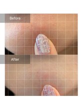 Oberio-オベリオ【結果重視！トータルビューティーサロン】/リアボーテ鎮静パック