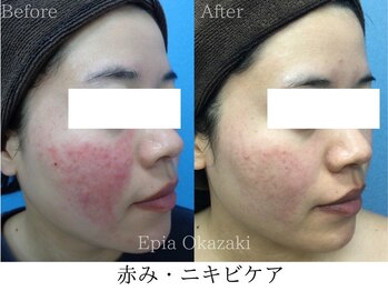 エピア 岡崎店(Epia)/赤み・ニキビケア
