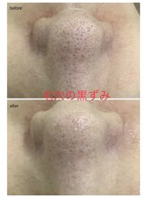 エスティ 梅田店/毛穴の黒ずみbefore/after