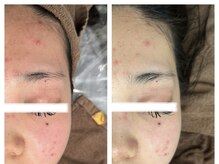 フェイン 青山店(fein.)/繰り返すニキビケアにも◎