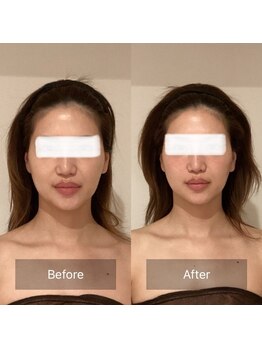 アラマンダ(Allamanda)/くまとり脂肪移植BeforeAfter