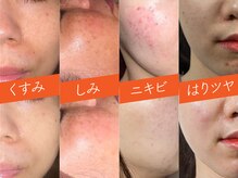 ビューティーリバース 大和店の雰囲気（お悩みに合わせたピーリング/光フェイシャルコースも充実！！）