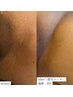 【粘膜もOK!!VIO脱毛】黒いお股→色も変わる・ハリ・臭い◎特許脱毛8000円