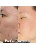 【再生美容×毛穴ケア】プロセル（Procell）幹細胞フェイシャル初回 ¥45,000