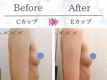 メディカルサロン エム エム エム 銀座プレミアムサロン(M.M.M.)/【バストアップ例】 C→Eカップ