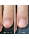 自爪育成3ヶ月コース