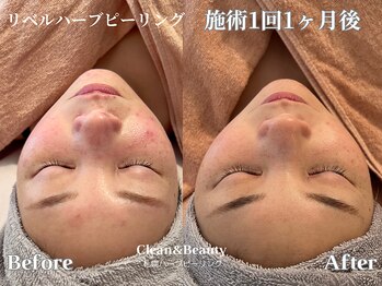 クリーンアンドビューティ 札幌(Clean&Beauty)/札幌リベルハーブピーリング♪