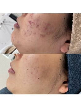 ラ クレール ビューティーサロン(LA CLAIR)/AHAピール×レチノールピール