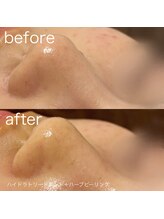 ルルラ リコ(lulula rico)/症例写真/ハイドラ毛穴洗浄