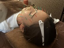 チャチャエイム整骨院 鍼灸院/【美容鍼】 根本から改善！