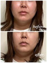 鍼灸庵利央/フェイスラインがスッキリ