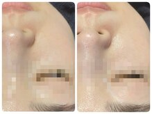 トータルビューティ ノイド(Noid)/毛穴洗浄　お試し全顔