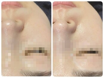 トータルビューティ ノイド(Noid)/毛穴洗浄　お試し全顔