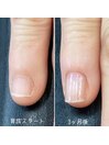 自爪育成3ヶ月コース