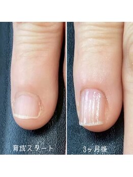 自爪育成3ヶ月コース