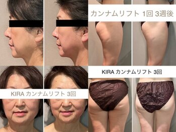 キラビューティー 二子玉川店(KIRA Beauty)の写真/身体の深部から温める韓国大人気の痩身「カンナムリフトPRO」で、気になるたるんだボディにアプローチ♪