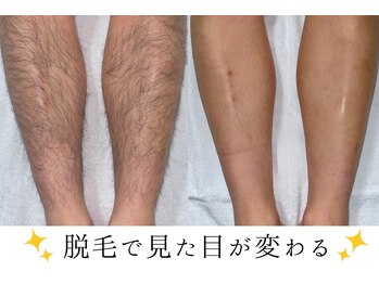 パーフェクトゼロ 札幌(.PERFECT.0.)/→ 男性の太い毛にも効果◎