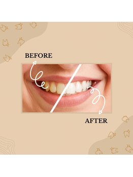 プラチナムビューティー 鳥取店(platinum beauty)/1Day集中プラン 20分照射×3 