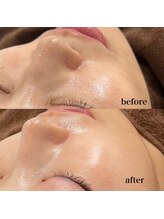 ホワイトラボ 梅田(White labo)/【施術例】ハイドロフェイシャル