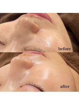 ホワイトラボ 梅田(White labo)/【施術例】ハイドロフェイシャル