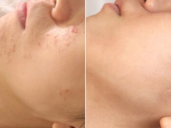 ハダイ(HADAY)/ニキビ改善｜ハーブピーリング