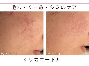 リリアン(lirien)/毛穴/毛穴ケア/毛穴洗浄/駒込