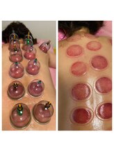 レイ(Lei)/カッピングのビフォーアフター