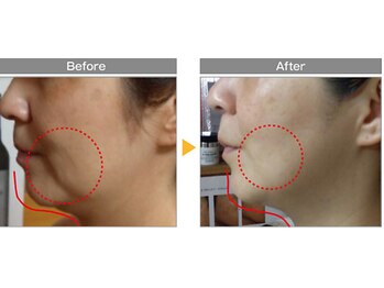 ポノ(pono)/WINBACKフェイシャル　たるみ