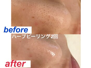 シイ(She)/ハーブピーリング