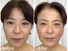 ドクターボディ 新宿店(Dr.Body)の雰囲気（60代　顔のたるみ・ほうれい線・マリオネットラインを改善）