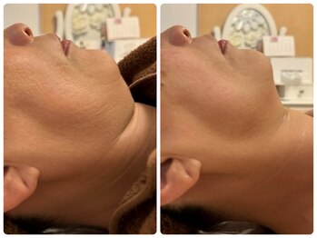 カレン(KAREN)/脂肪増量+セルゼロ小顔#たるみ