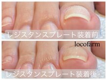 ロコ ファーム(loco farm)/巻き爪ケア