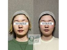 キュープ 相模原淵野辺店(Qpu)/たった4回で人生で1番小さな顔に