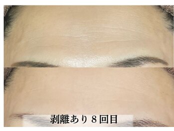 ラビエス(LAVIES)/【40代】おでこのシワが嫌で