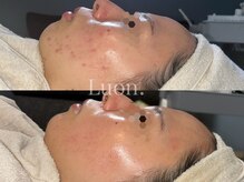 ルオン(Luon.)/ハーブピーリング/ニキビケア