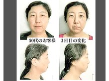 ベルフィオーレ/小顔矯正＆TGF導入の結果です