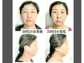 ベルフィオーレ/小顔矯正&TGF導入の結果です