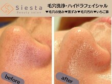 シエスタ(siesta)/再ブーム到来の毛穴洗浄！