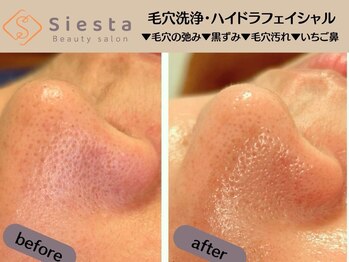 シエスタ(siesta)/再ブーム到来の毛穴洗浄！