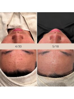 ハル(haru)/ビフォーアフター