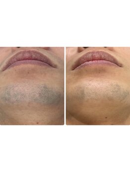 エリクサー 太田店(Elixir)/before after