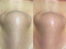 ヴィーヴ 京橋(vive)/【韓国式3D毛穴洗浄】