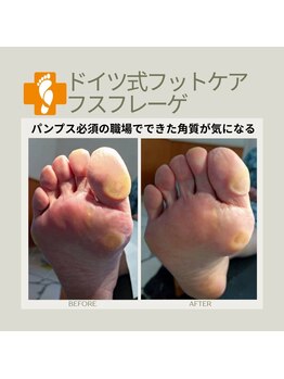 フスフレーゲ 学芸大学店/パンプスの角質のお悩み