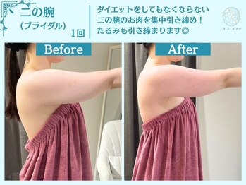 フローフシ∞/【痩身/たるみ】ブライダル痩身