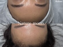 ナチュールムーン(Nature moon.)/ハーブピーリング